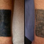 Gang Tattoo Removal – It Conserve You Your Life