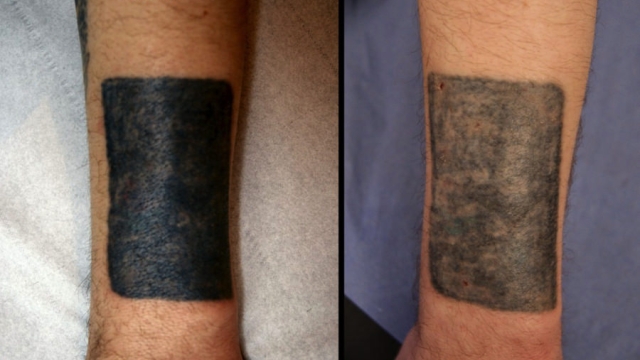 Gang Tattoo Removal – It Conserve You Your Life
