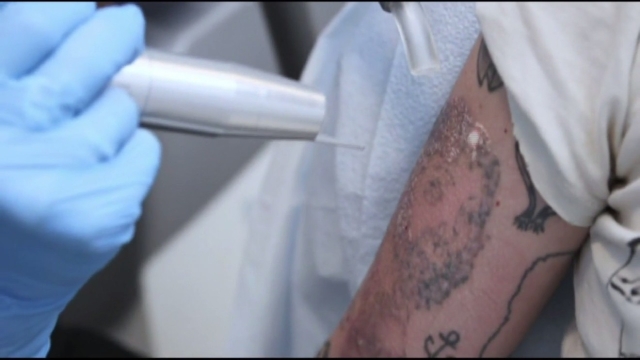 Tattoo Removal Options – Available Techniques To Remove It
