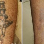Remove Tattoos Yourself – What Is It Possible To Do To Get A Tattoo?