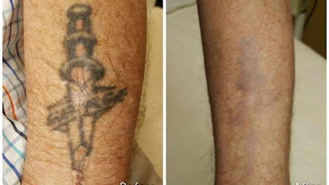 Remove Tattoos Yourself – What Is It Possible To Do To Get A Tattoo?