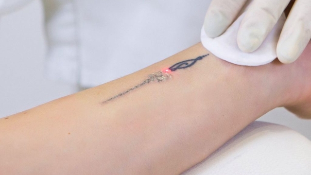 Tattoo Laser Removal – 7 Facts You Must Know About Removing Tattoos By Laser