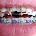 Unlocking the Secrets of a Perfect Smile: The Orthodontist’s Guide
